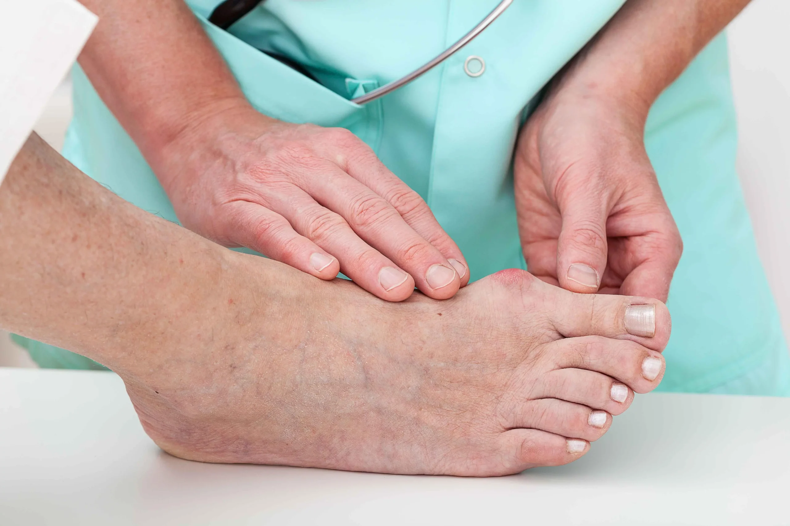 bunion treatment in livingston, nj