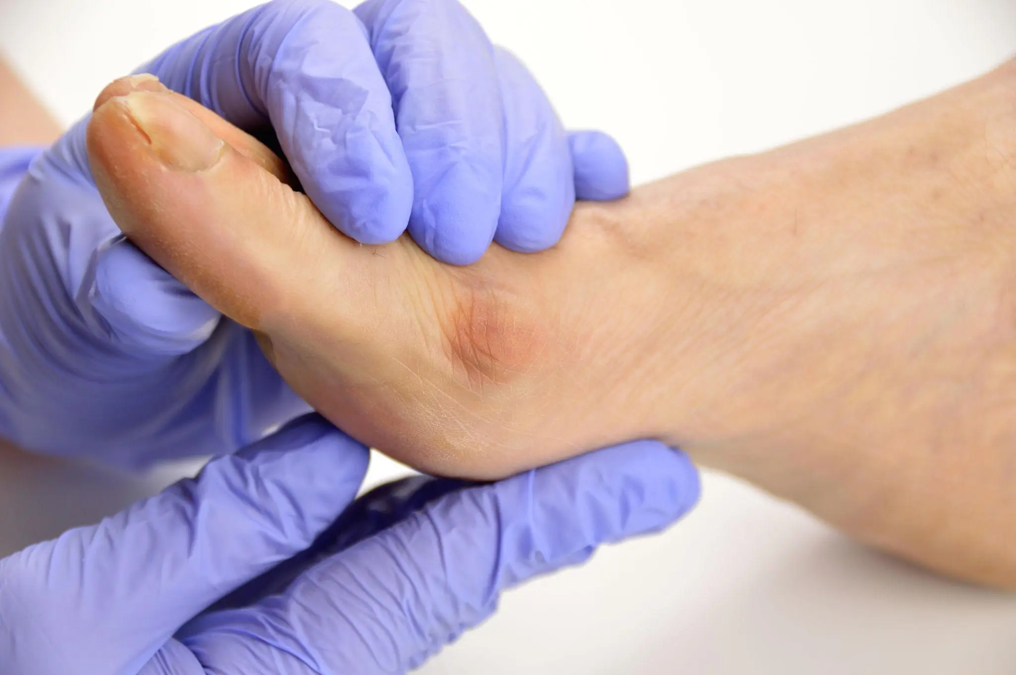 bunion treatment near you