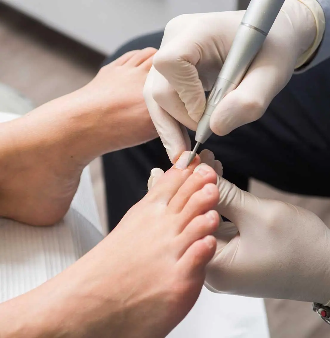 toenail fungus treatment in livingston, nj