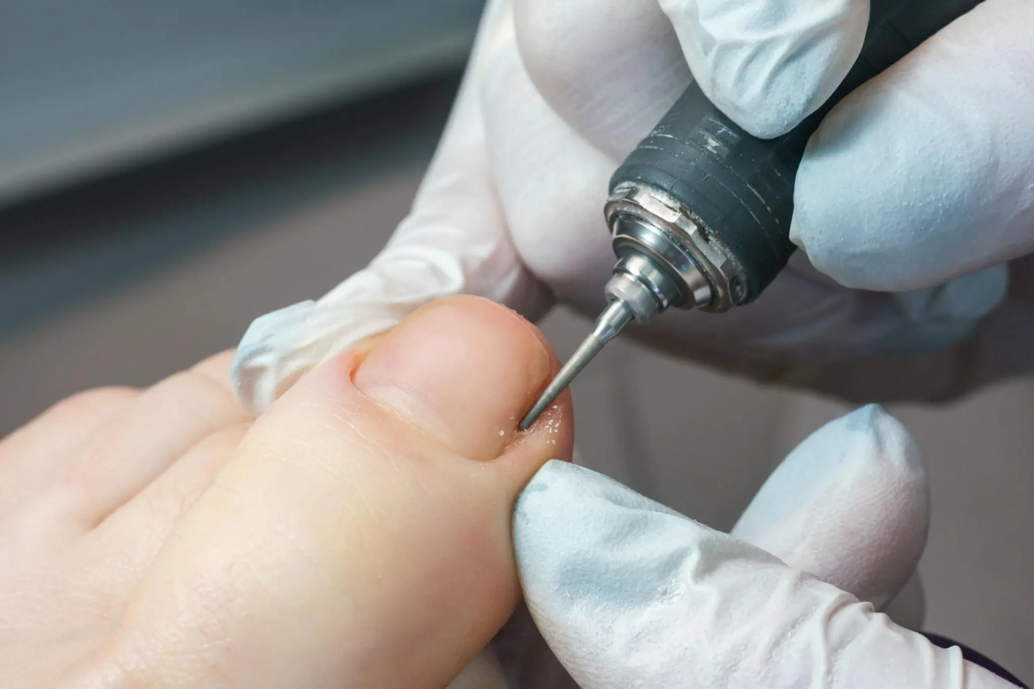 toenail fungus treatment near you