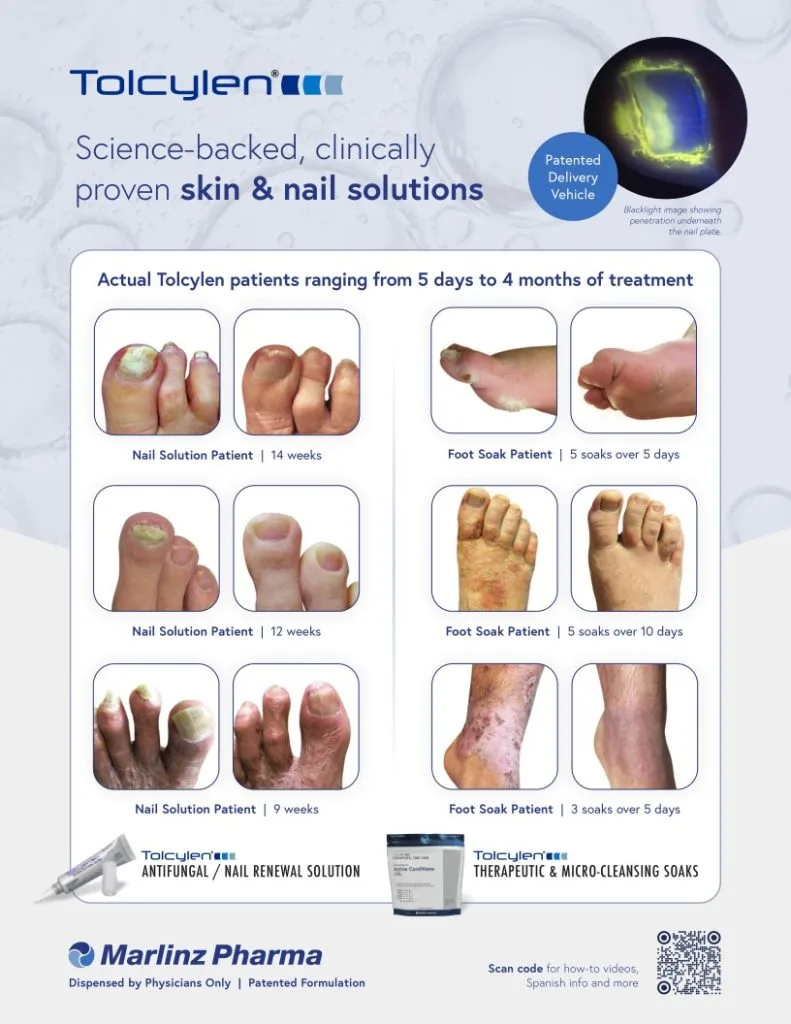 tolcylen antifungal nail renewal solution applicator tube and application instructions guide at goldberg podiatry center