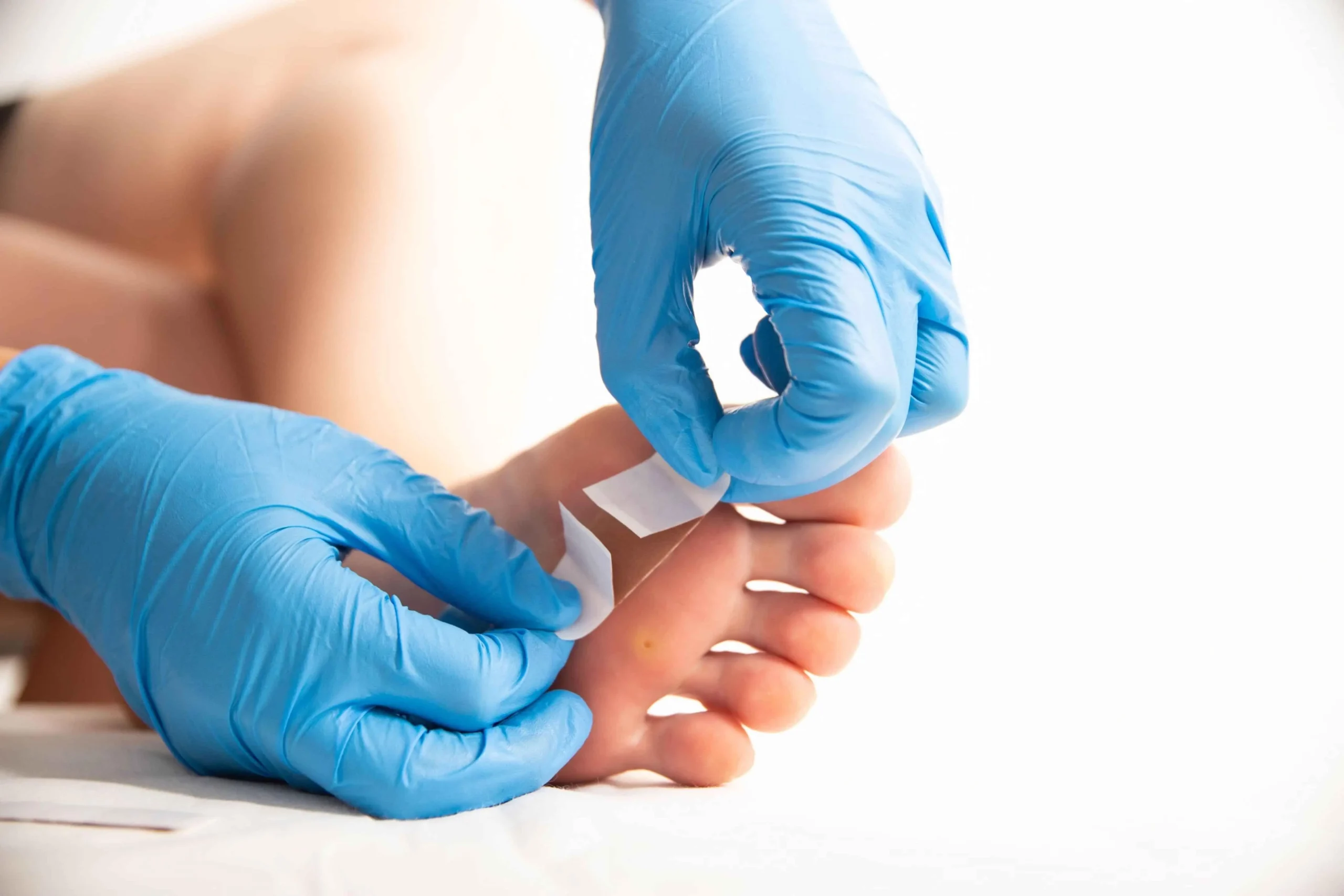 wart treatment in livingston, nj