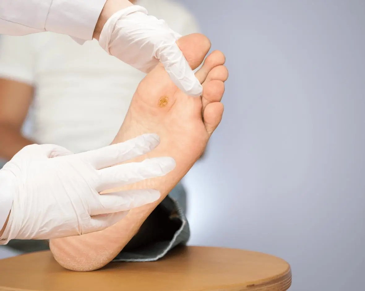 wart treatment near you